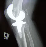 Zimmer purchases joint assets of Knee Creations.